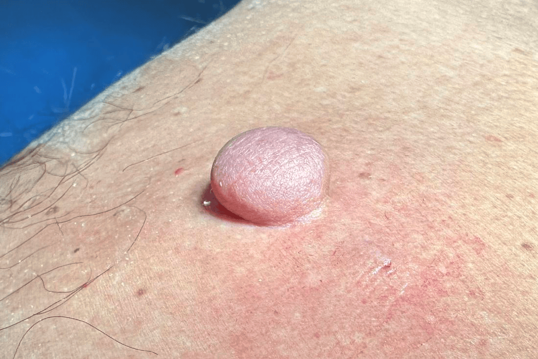 Fibrom_vorher